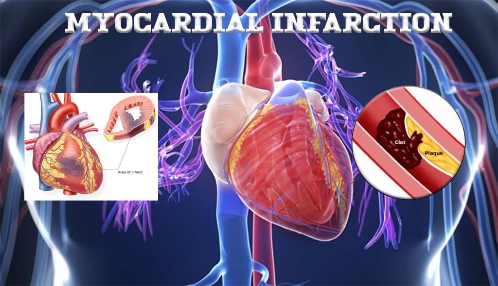 EVIDENCE BASED PRACTICE – OSCE                     female myocardial infarction