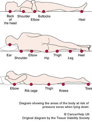 OSCE PRESSURE AREA ASSESSMENT – Questions $ Answers