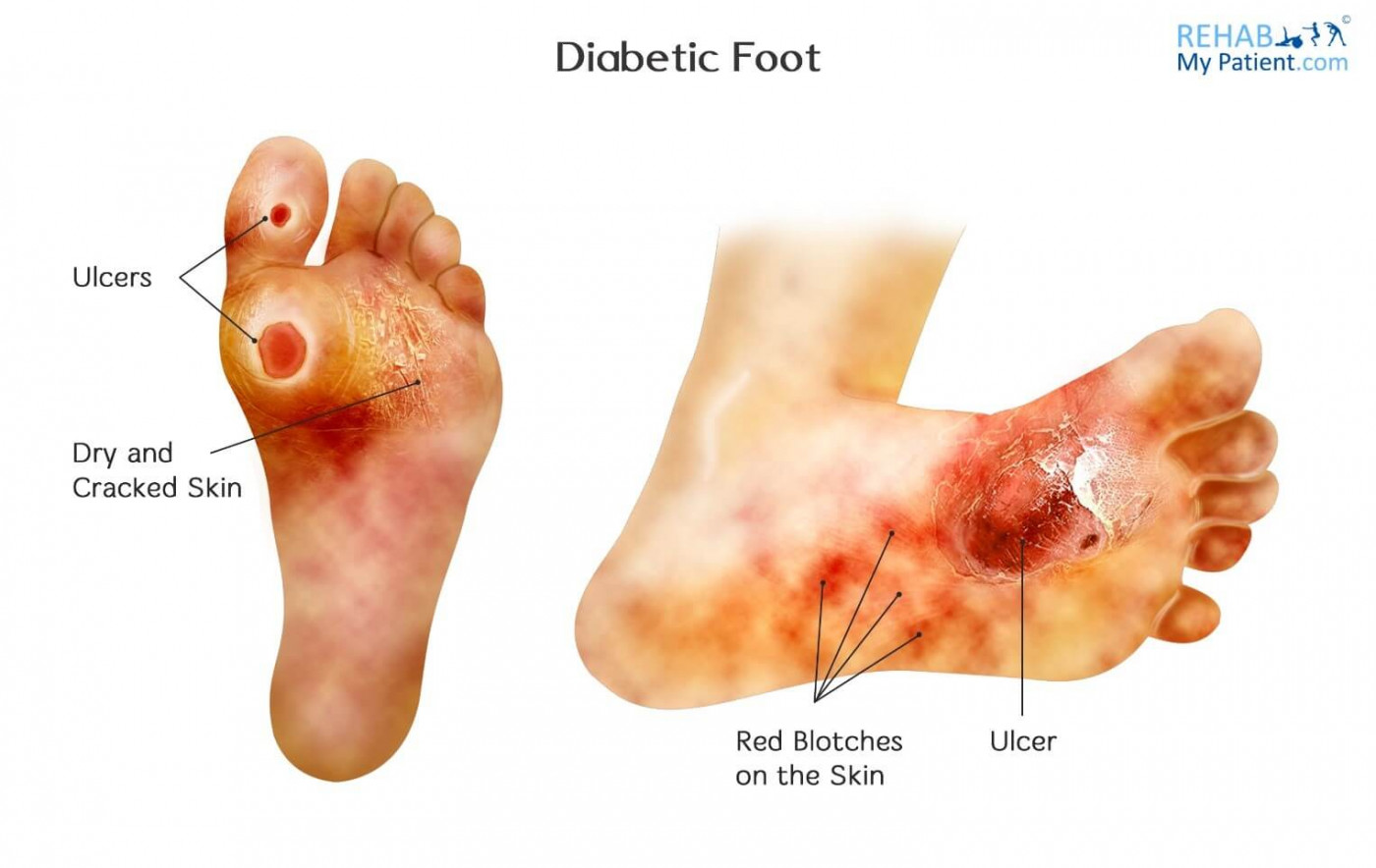 AUTHENTIC HOME REMEDY FOR DIABETIC ULCERS