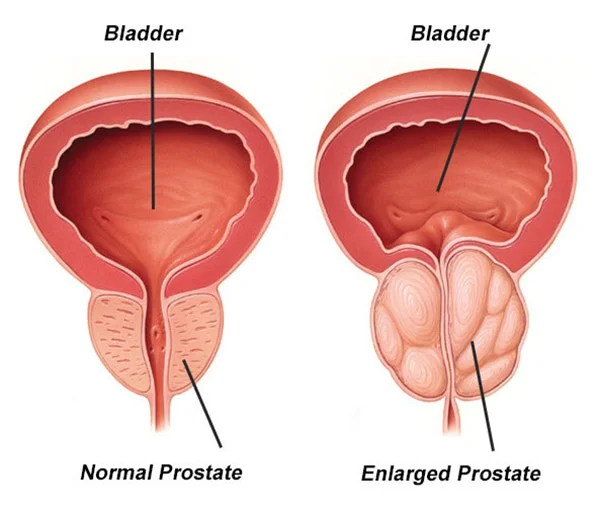 TREATING PROSTATE ENLAGEMENT WITHOUT MEDICINE