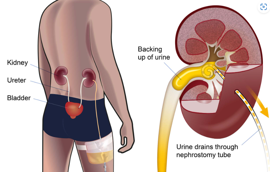 NEPHROSTOMY: OVERVIEW AND COMPREHENSIVE CARE GUIDE